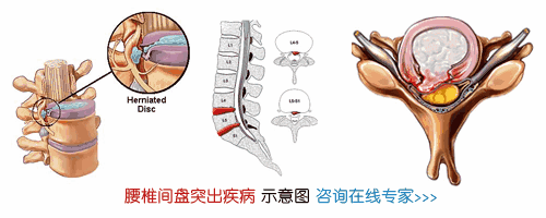 膨出3.jpg